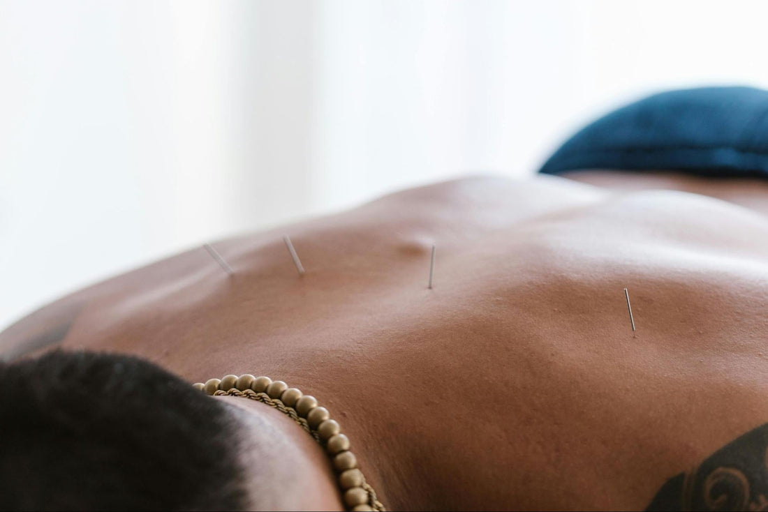 Acupuncture for Back Pain Melbourne: Natural Support for Lower Back Pain, Stiffness and Mobility