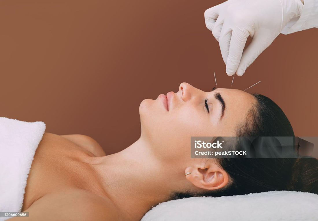 Acupuncture for Migraines Melbourne: Natural Support for Headaches, Tension and Stress