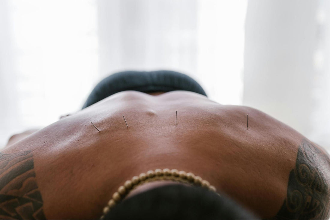Acupuncture for Back Pain: A Natural Approach to Supporting Mobility and Wellbeing